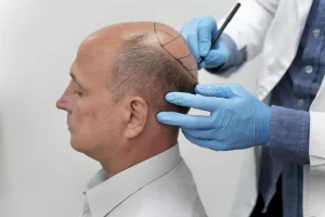 4000 Grafts Hair Transplant Cost in Turkey- A Comprehensive Overview