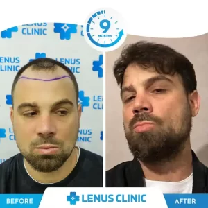 hair transplantation beforeafteralp