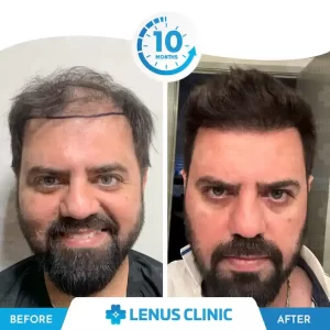 hair transplantation beforafterkah