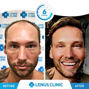 Lenus Clinic- Hair Transplantation Before After