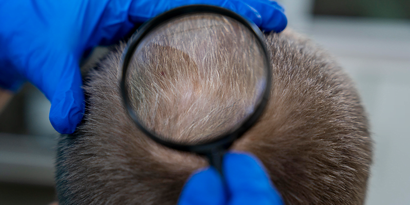 FUE vs FUT for Different Hair Types