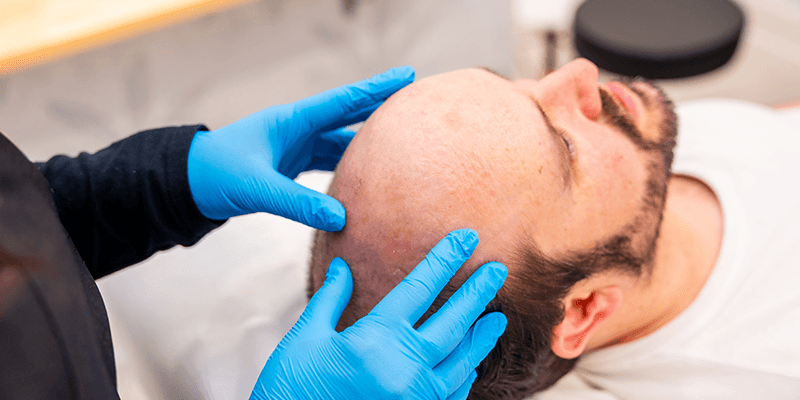 Factors Affecting the 3000 Grafts Hair Transplant Cost in Turkey