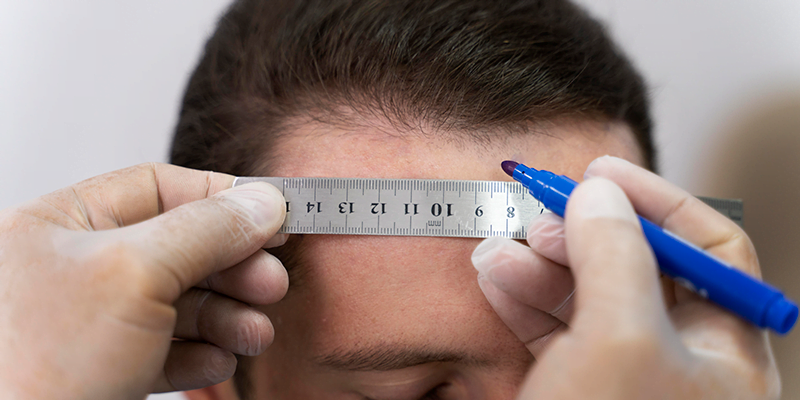 How Many Grafts Are Needed for a Hair Transplant