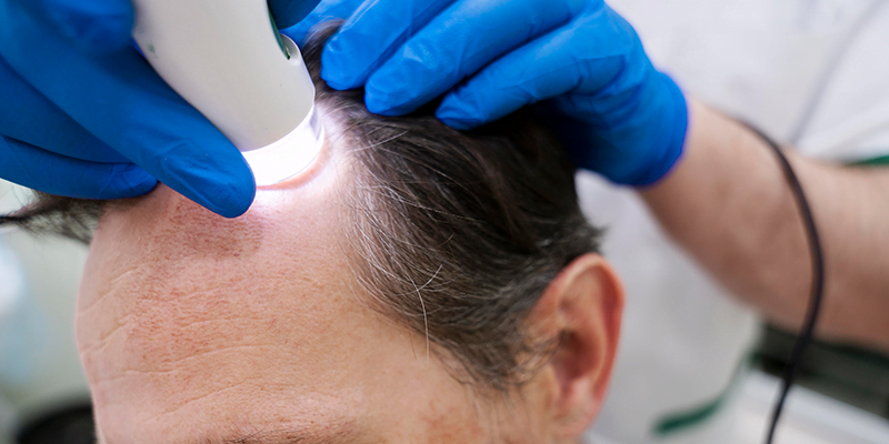 How to Budget for a Hair Transplant