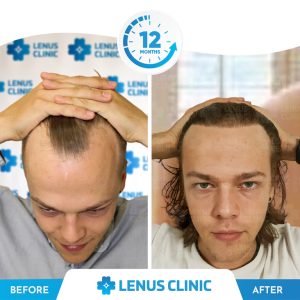 Lenus Clinic- Hair Transplant Before After