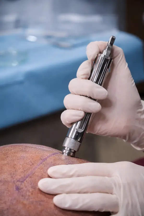 Advanced Hair Restoration in Turkey 28 Painless