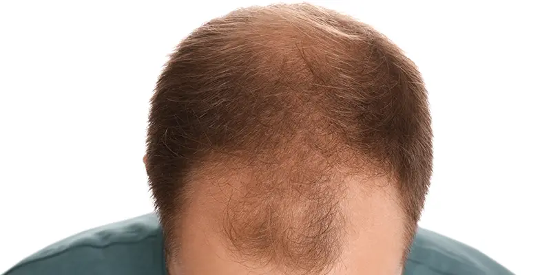 DHI Hair Transplant